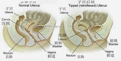 子宫后屈