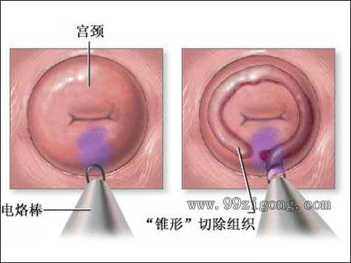 锥切后的宫颈图片