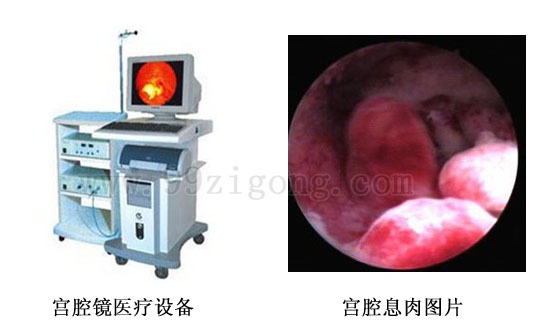 宫腔镜检查图片
