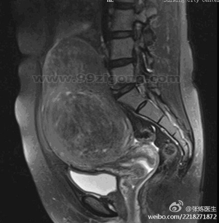 MRI检查下的子宫肌瘤图片