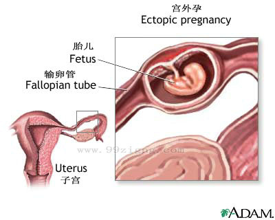 宫外孕图片