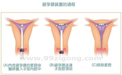 子宫内避孕器（子宫环）安装过程