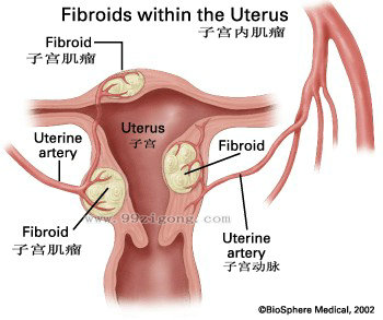 子宫肌瘤示意图