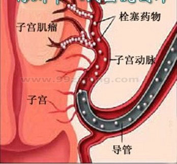 子宫动脉栓塞手术示意图