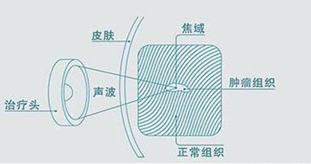 遂宁市中心医院海扶刀®治疗量再创世界新高，无创新技术造福广大患者