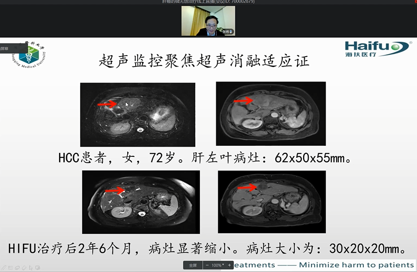 一起战‘疫’危急重症肝癌的微无创治疗