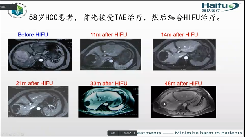 一起战‘疫’危急重症肝癌的微无创治疗