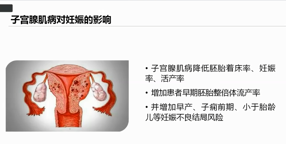 解读热点 疫情期间子宫腺肌病的微无创治疗