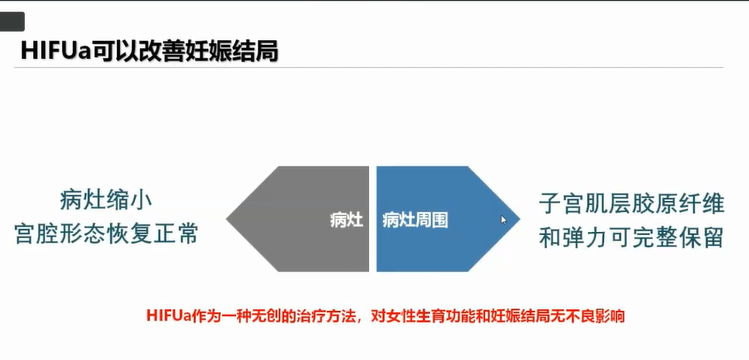 解读热点 疫情期间子宫腺肌病的微无创治疗