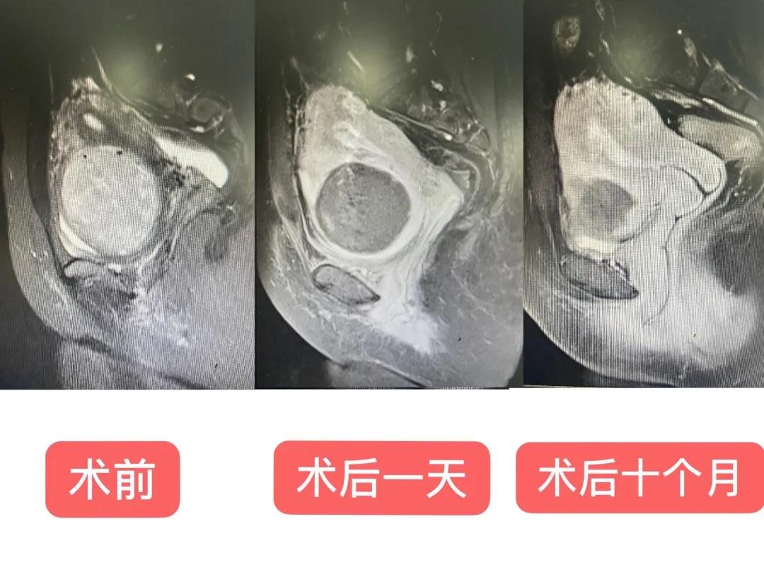 绍兴第二医院海扶®微无创治疗中心成立一周年 给253个家庭带去幸福