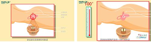 不开刀不流血没有疤 赣医一附院引进海扶刀®无创治疗子宫肌瘤