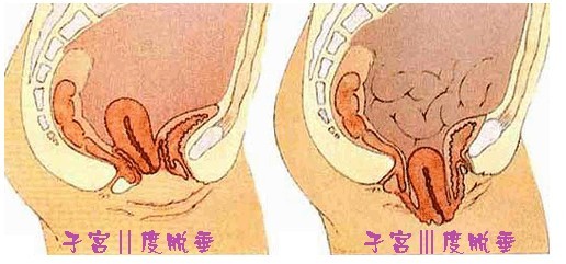 子宫脱垂