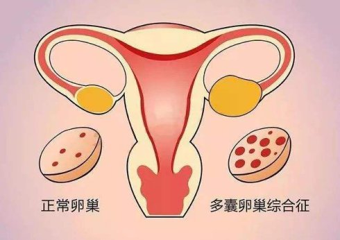 多囊卵巢综合征