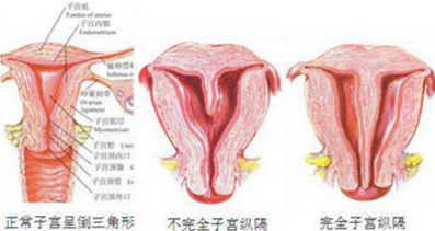 纵膈子宫