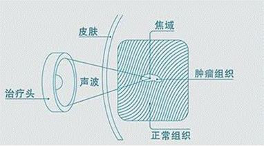 喜讯！邵东市人民医院引进本市首台海扶刀®