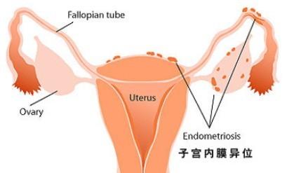 子宫内膜异位症