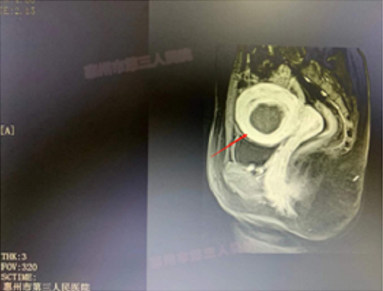 不开刀、不流血，女性福音！惠州三院首例子宫肌瘤聚焦超声消融手术顺利完成！