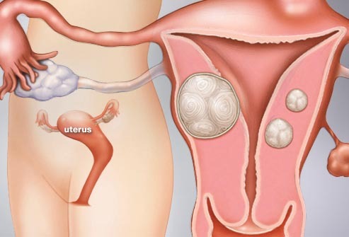 子宫肌瘤有哪些危害，如何预防？