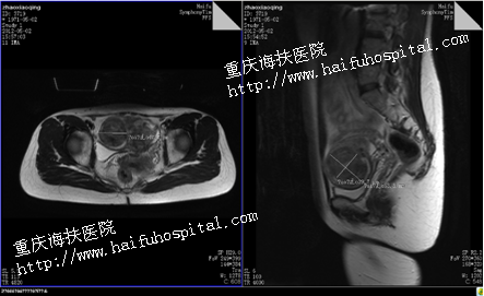 Preoperative MRI image