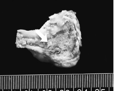  Coagulative necrosis and congestion rim surrounding ablated tissue