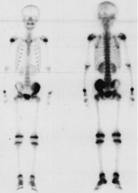 99mTc-MDP SPECT before high intensity focused ultrasound treatment
