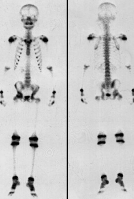  Fourteen days after high intensity focused ultrasound