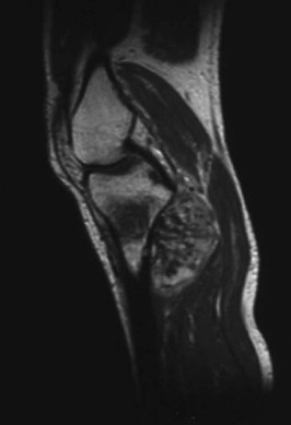 Contrast-enhanced magnetic resonance image before high intensity focused ultrasound ablation.