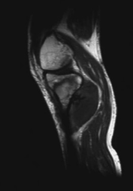 Contrast-enhanced magnetic resonance image obtained fourteen days after high intensity focused ultrasound